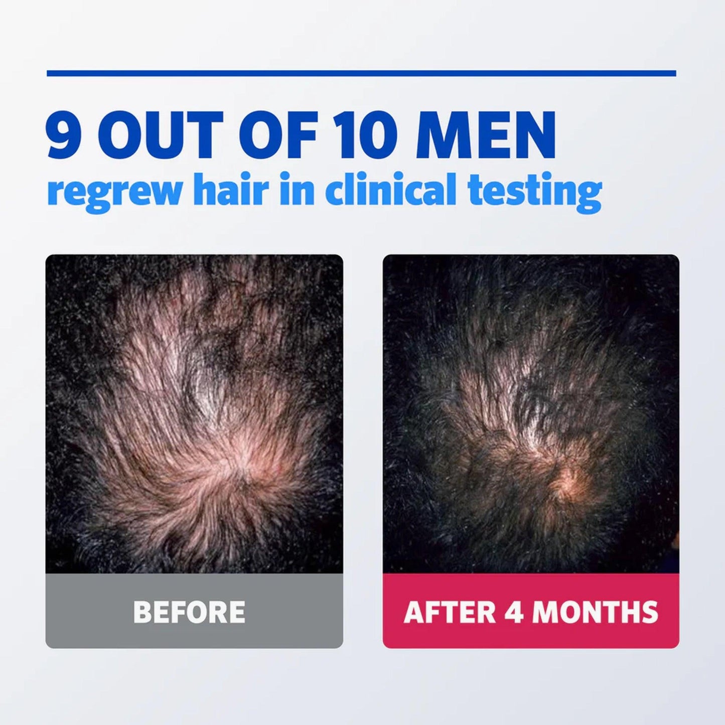 Rogaine For Men 5% Minoxidil Topical Aerosol Hair Regrowth Treatment Easy-To-Use Foam 3 Month Supply Set - TheSkinFit