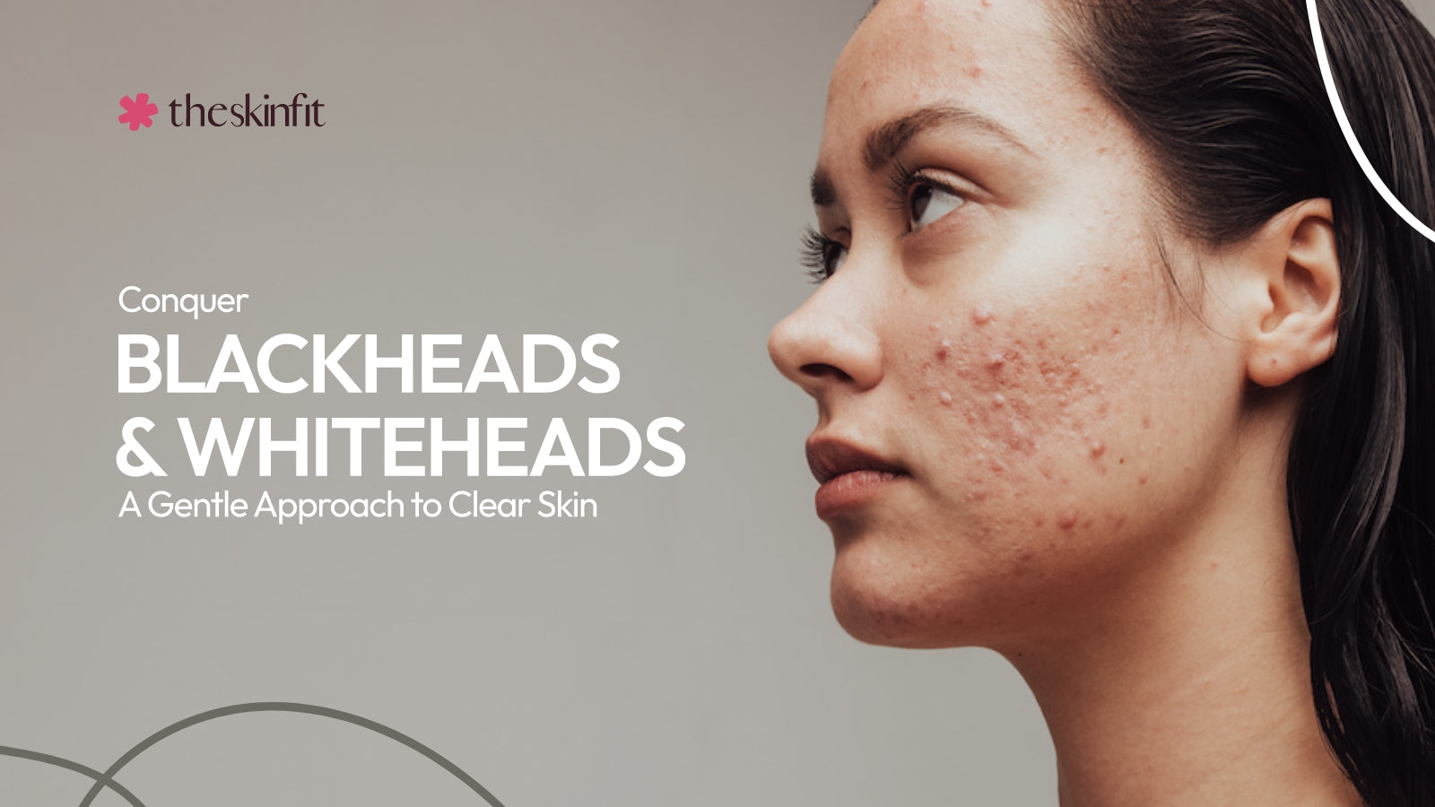 Conquer B;ackheads and Whiteheads