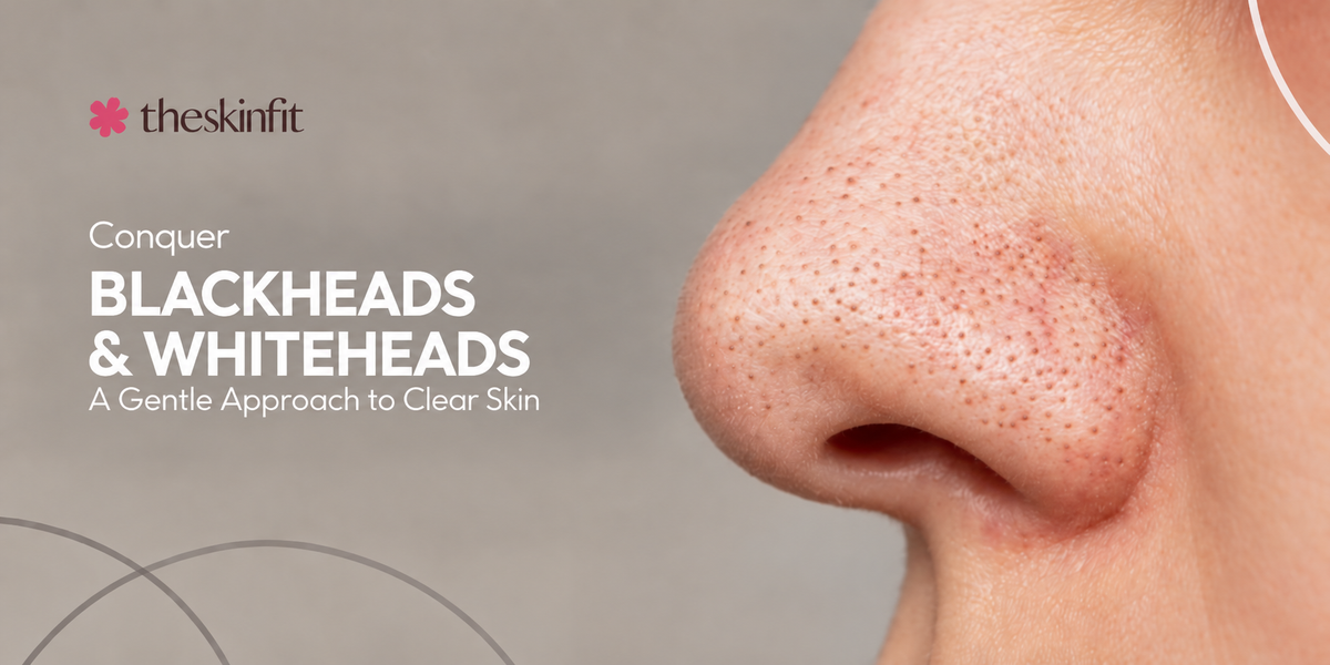 Conquer Blackheads and Whiteheads: A Gentle Approach to Clear Skin