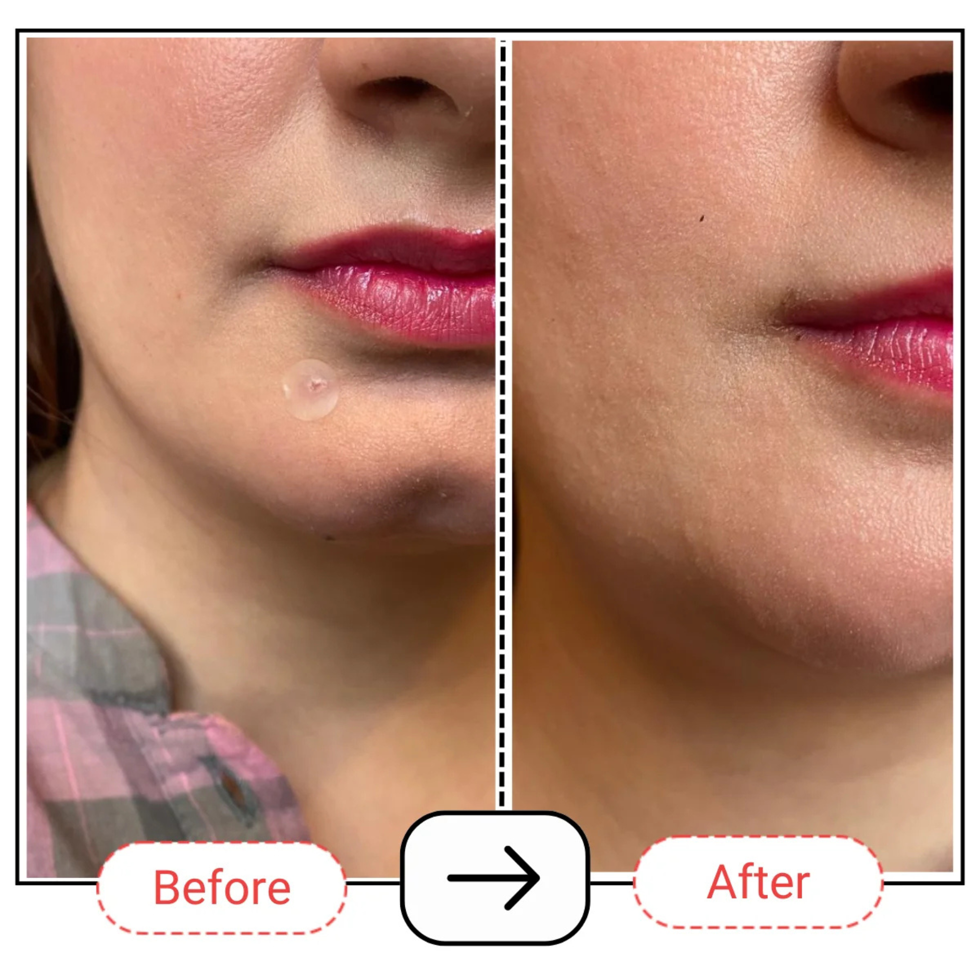 AccuFix Cosmetics Hydrocolloid Pimple Patches