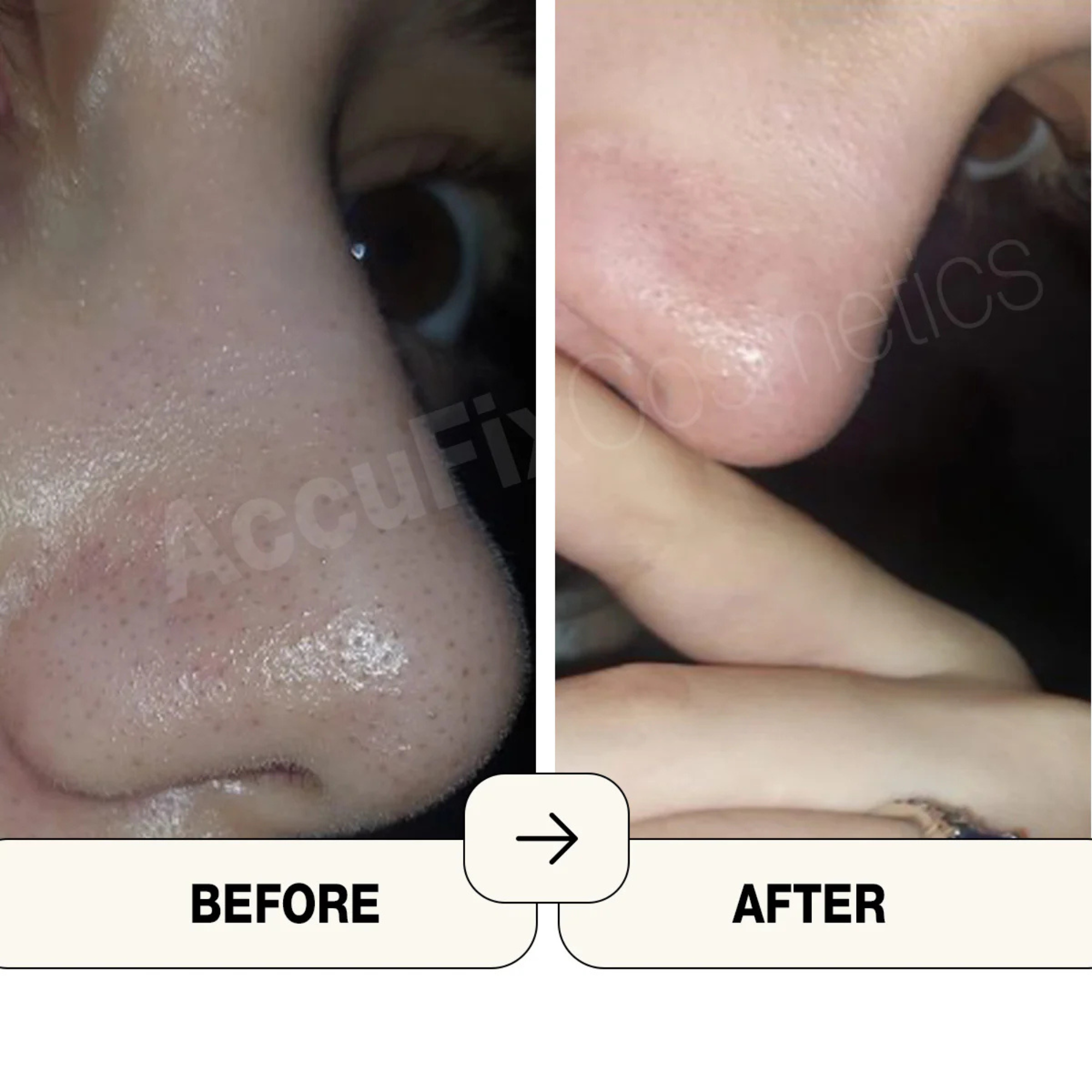 AccuFix Cosmetics Salicylic Acid Cream
