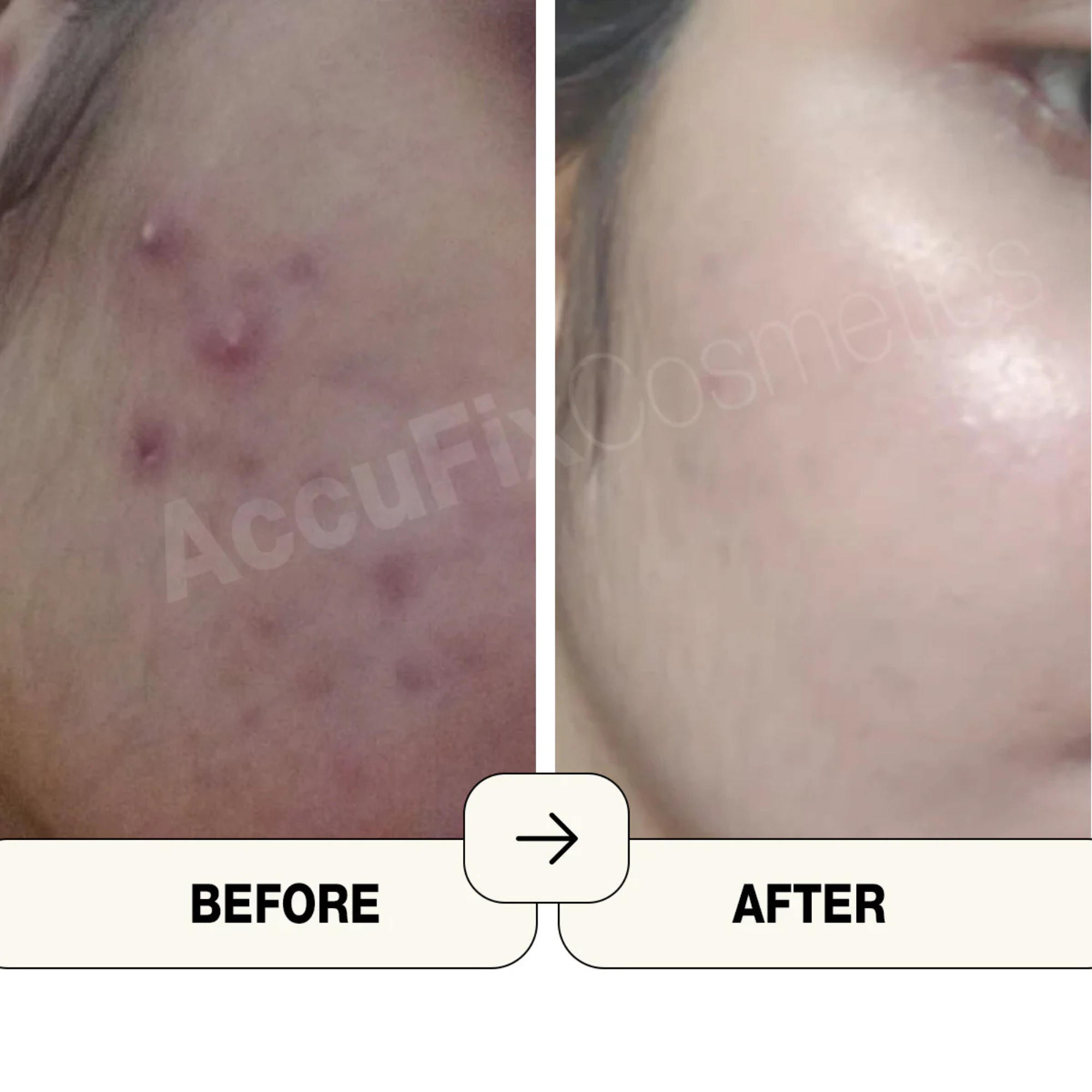 AccuFix Cosmetics Salicylic Acid Serum | BHA Serum