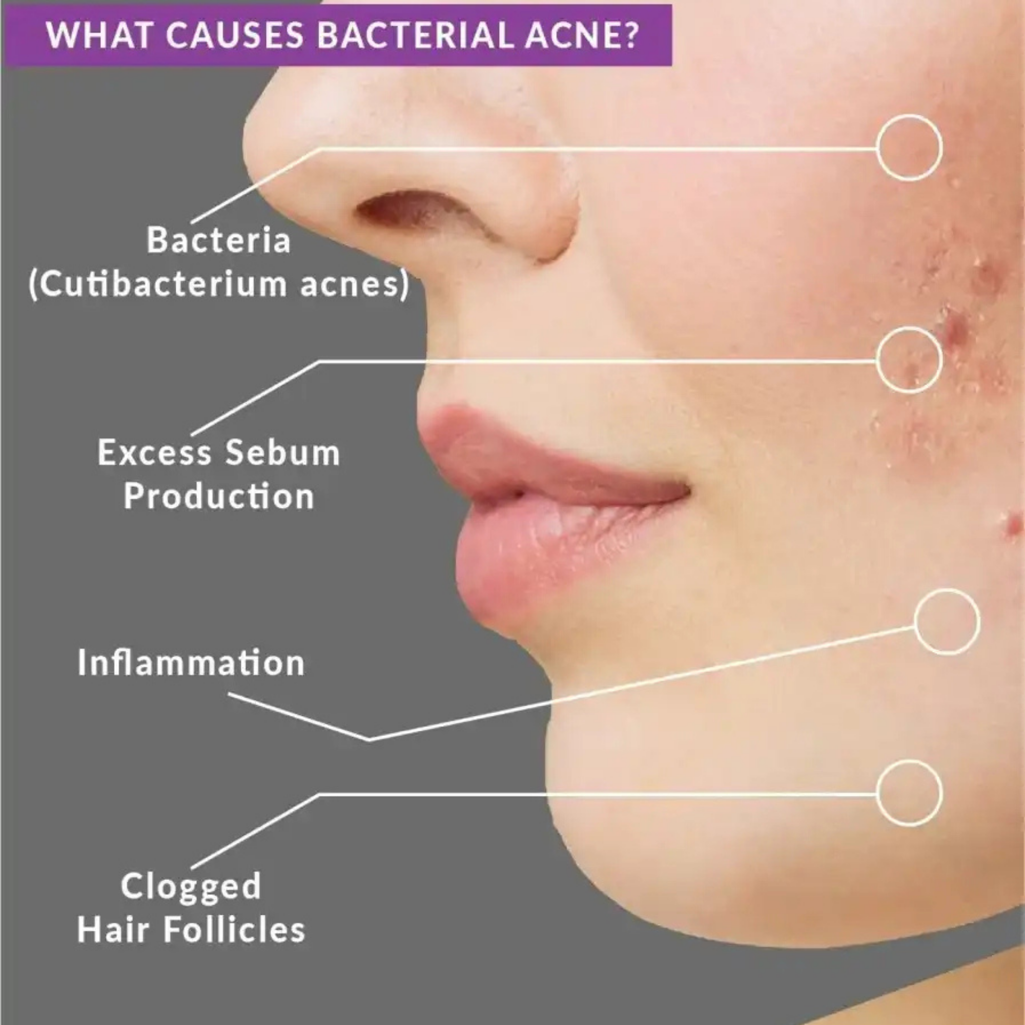Beautenic Benzoyl Peroxide Acne Treatment Toner price in Pakistan