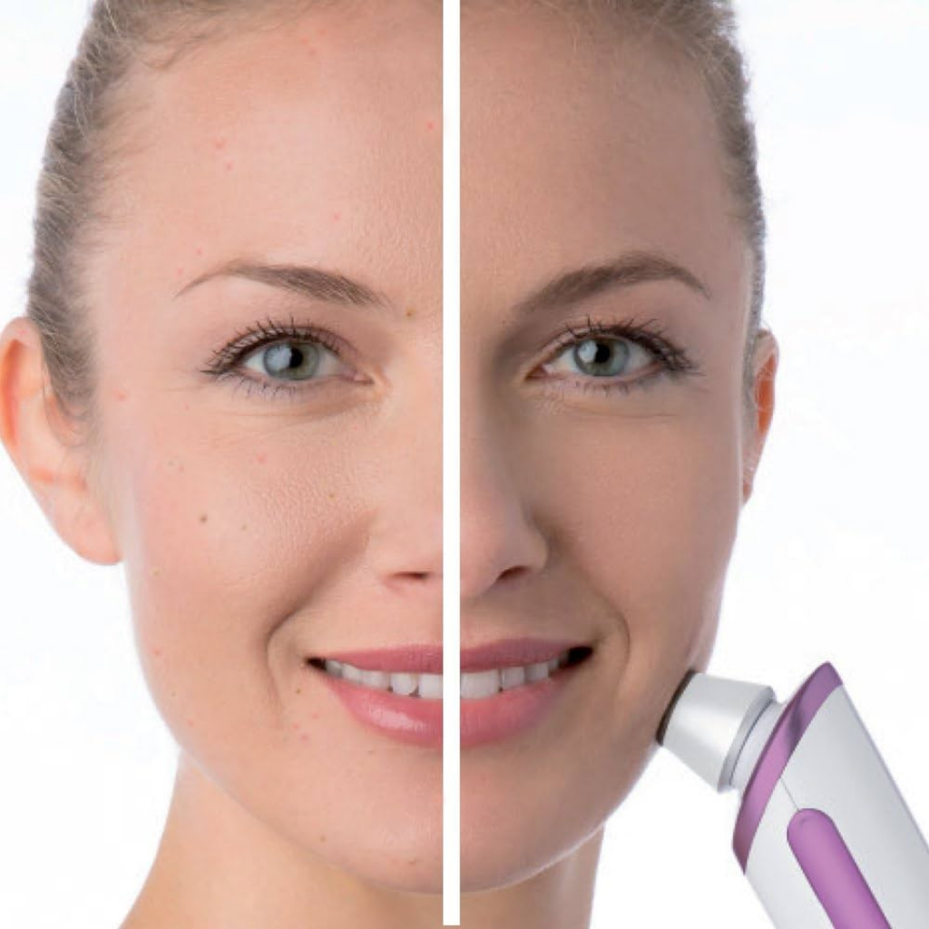Beurer Microdermabrasion FC-76 Before | After Image