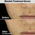 COSRX The AHA 2 BHA 2 Blemish Treatment Serum how to use