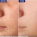 Jenpharm NiaRonic Acne Control Serum