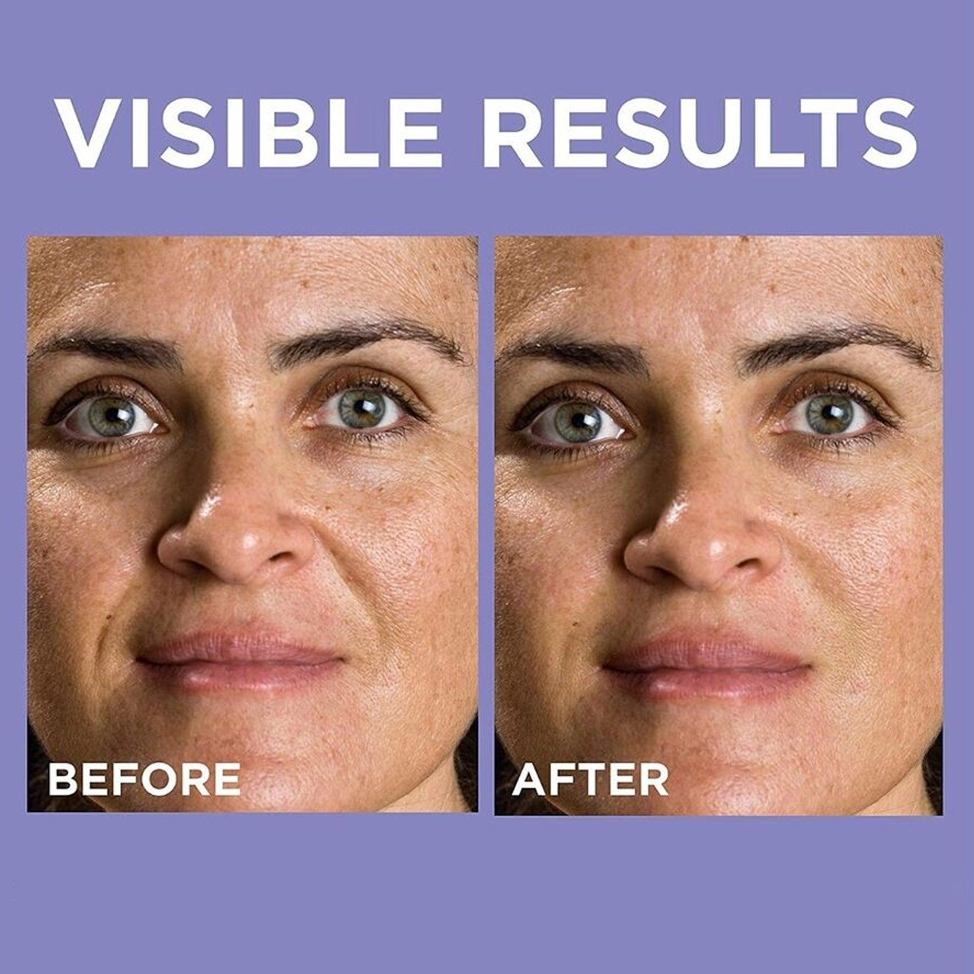 L'Oreal Paris Revitalift 1.5% Hyaluronic Acid Serum 15ml - TheSkinFit