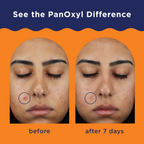 PanOxyl Acne Clearing Spot Treatment 10% Benzoyl Peroxide