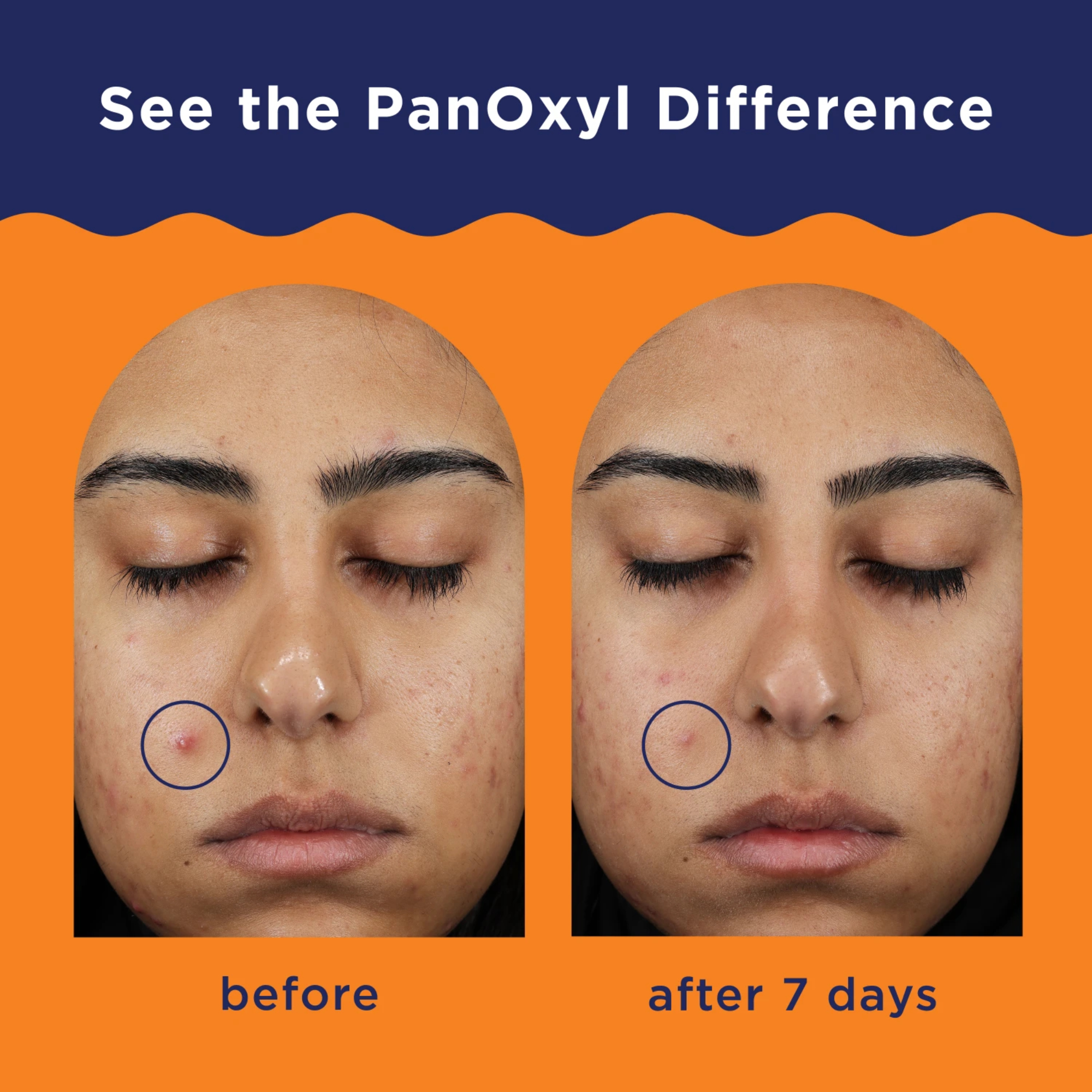 PanOxyl Acne Clearing Spot Treatment 10% Benzoyl Peroxide