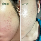 Skin Deep Acne Clarifying Serum