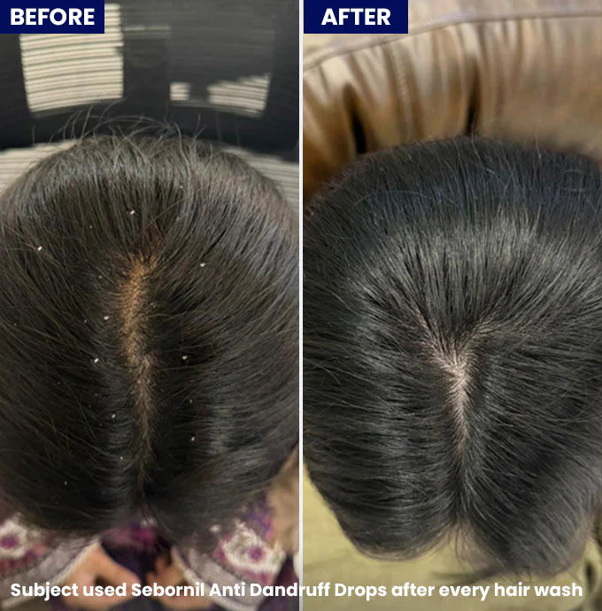 Jenpharm Sebornil Anti-Dandruff Drops For All Scalp Type 50ml price in Pakistan