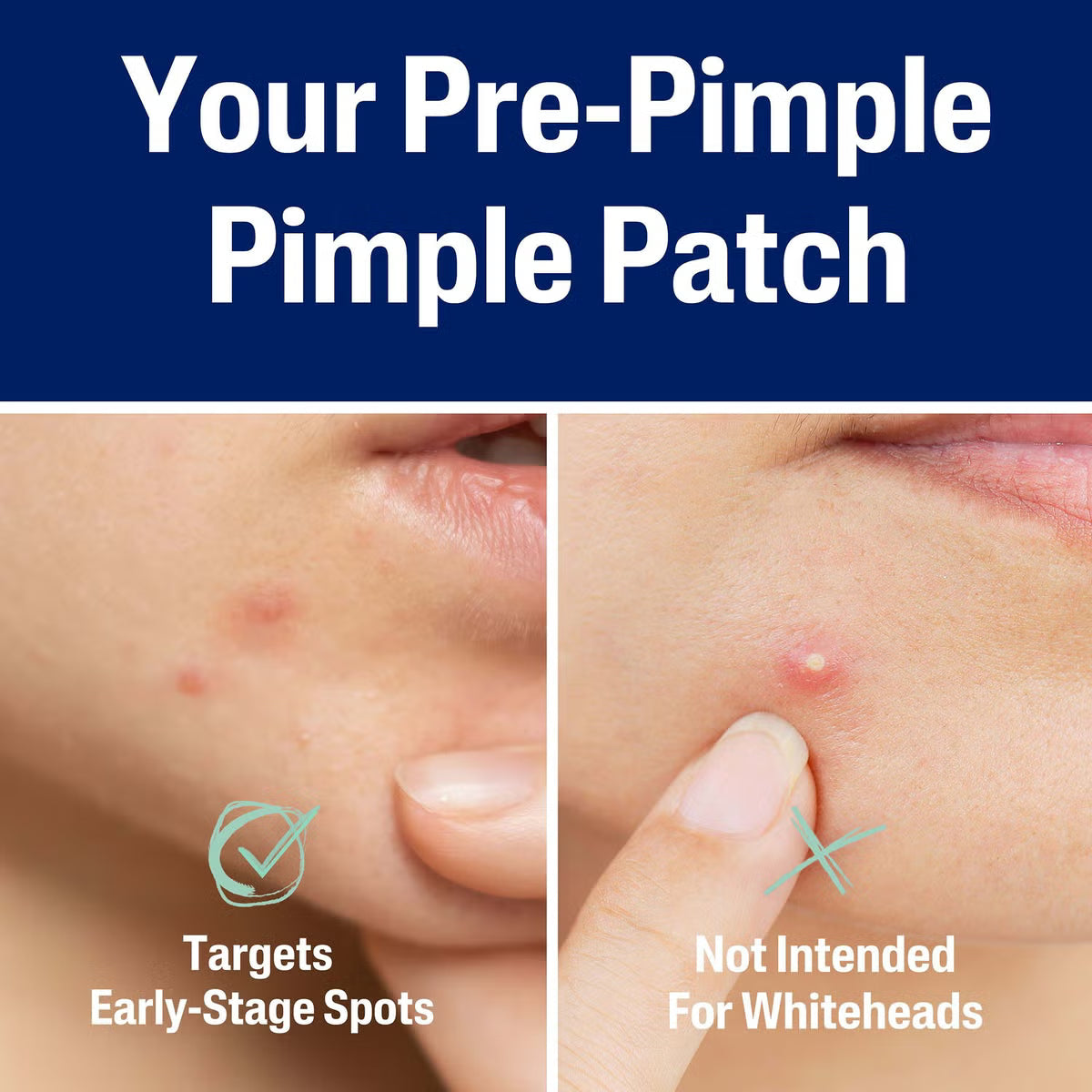 Pure O Fresh Pimple Patch 36 Patches
