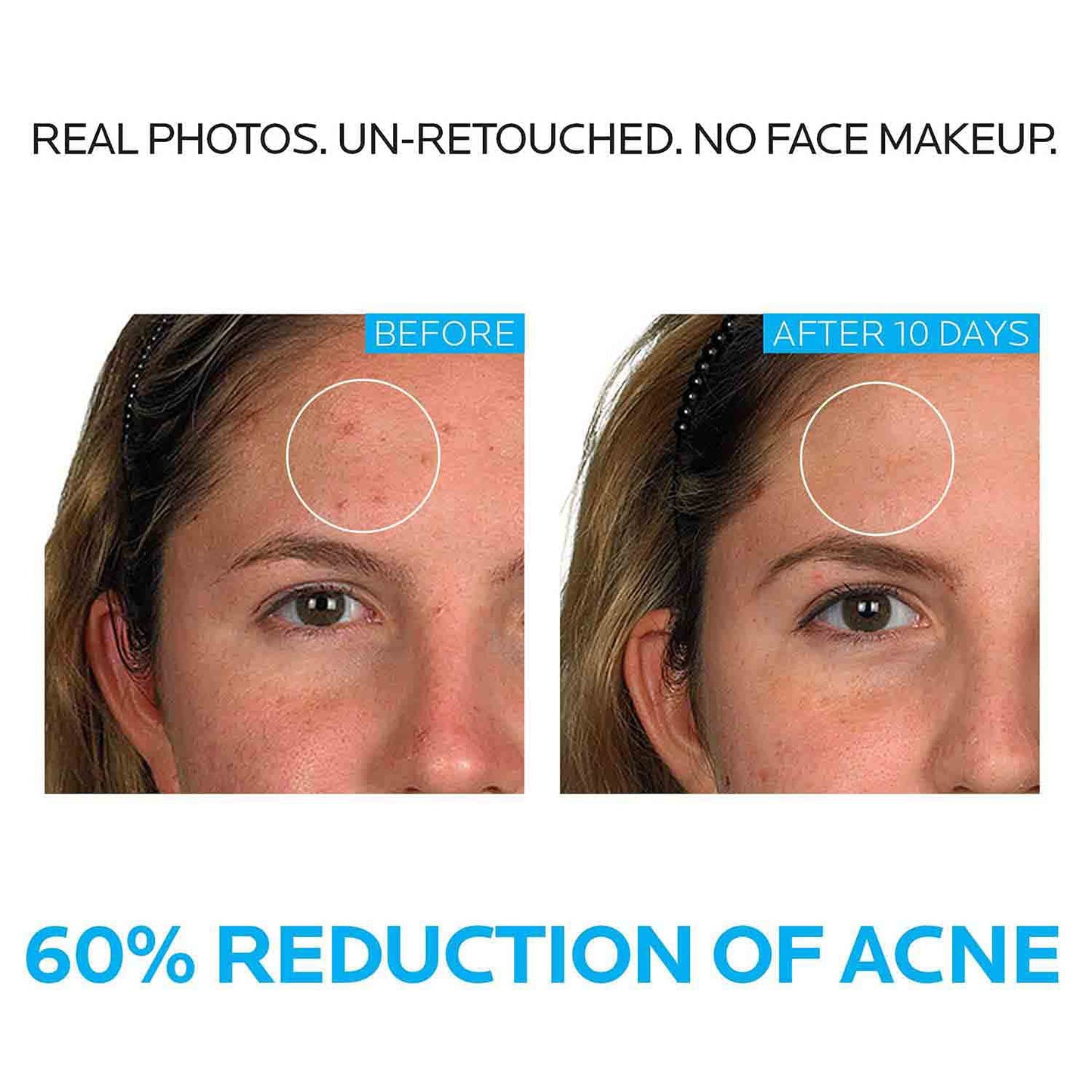 La Roche-Posay Acne Innovation Dermatological Acne System Set
