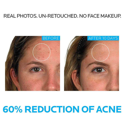 La Roche-Posay Acne Innovation Dermatological Acne System Set