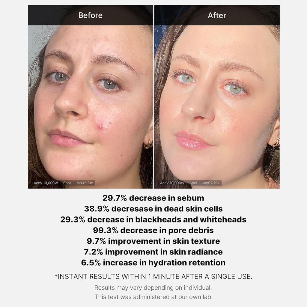 Medicube 1 Min Red Acne Succinic Acid Peel 40gm - TheSkinFit