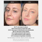 Medicube 1 Min Red Acne Succinic Acid Peel 40gm - TheSkinFit