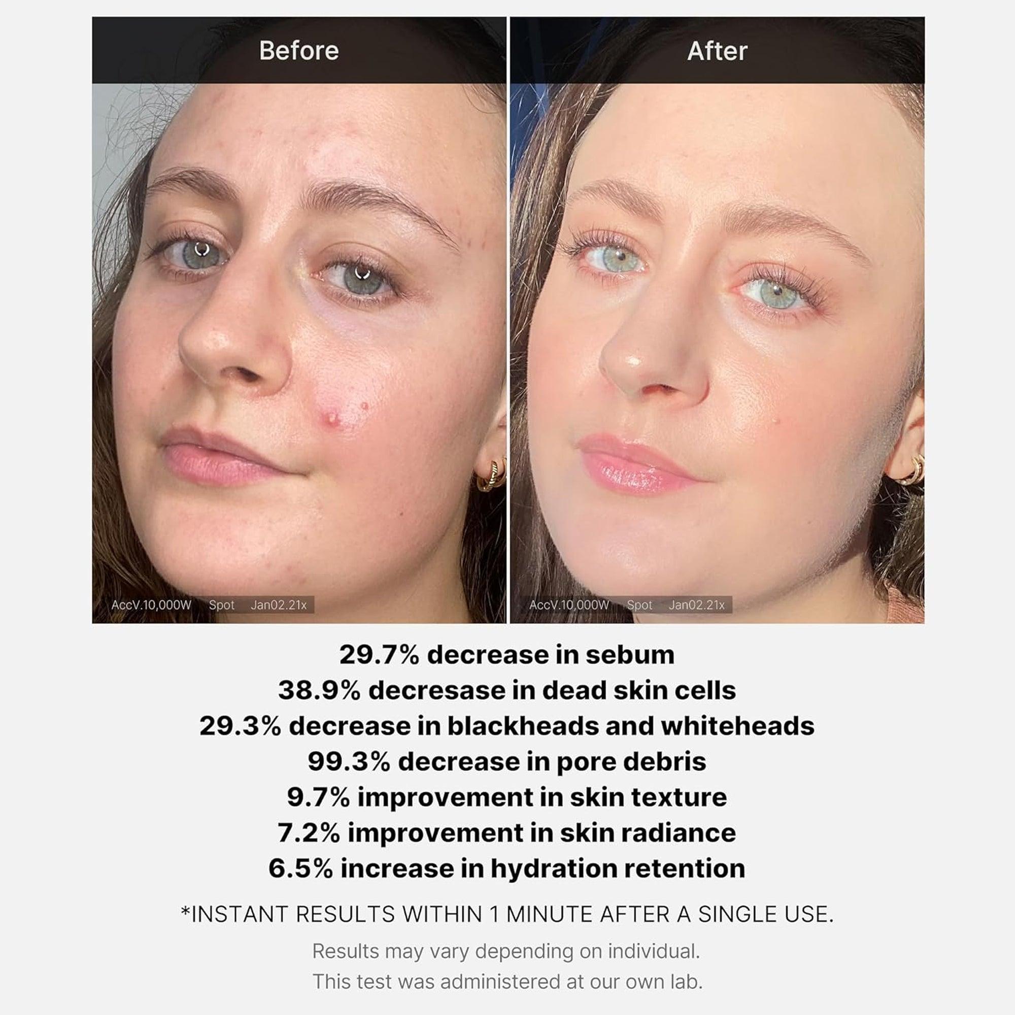Medicube 1 Min Red Acne Succinic Acid Peel 40gm - TheSkinFit